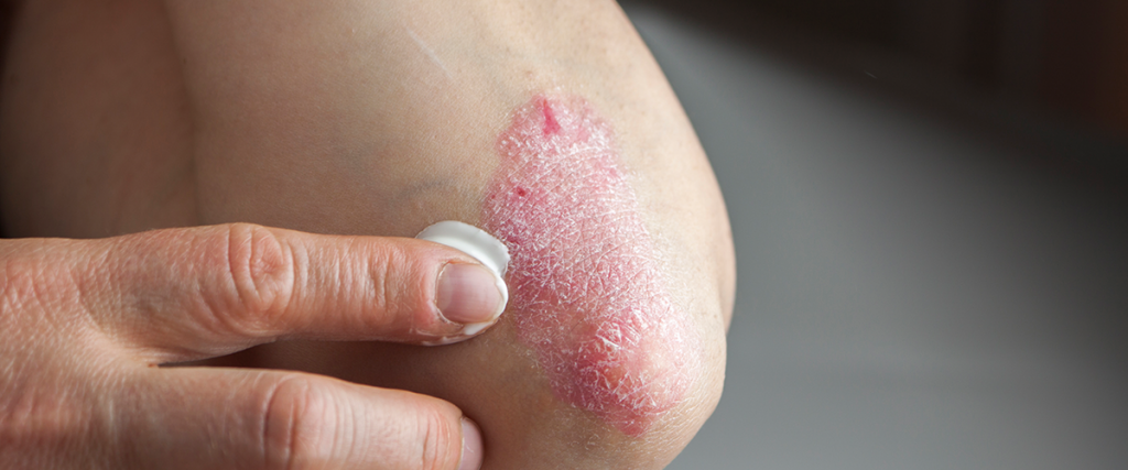 CBG for psoriasis